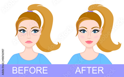 Plastic surgery of eyelids, operation removal of bags under eyes. Blepharoplasty. Beautiful female face before and after. Vector illustration.