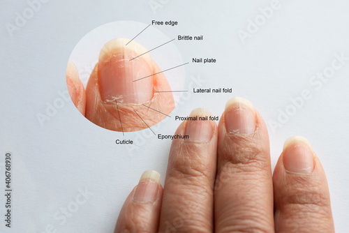 Tablou pe pânză Zoom in image of Finger nail anatomy guides from real finger with brittle nail,