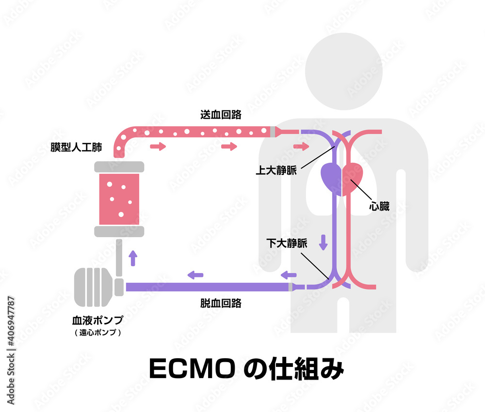 ECMO (エクモ) ・体外式膜型人工肺 の構造と仕組み /新型コロナウイルス, Covid19 Stock Vector Adobe