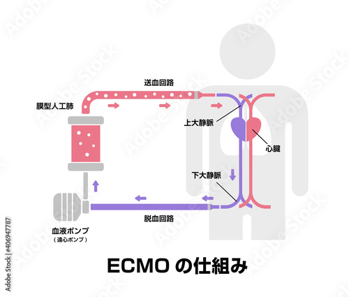 Ecmo エクモ 体外式膜型人工肺 の構造と仕組み 新型コロナウイルス Covid 19 Stock Vector Adobe Stock