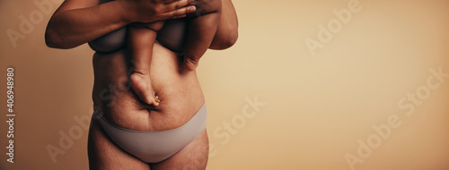 Postpartum belly with stretch marks photo