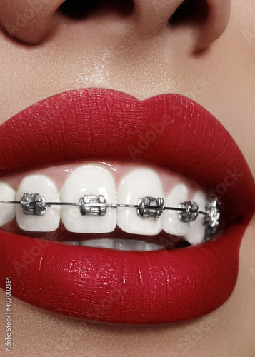 Beautiful white teeth with braces. Dental care photo. Woman smile with ortodontic accessories. Orthodontics treatment