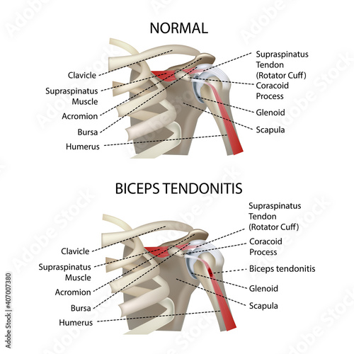 biceps tendonitis, shoulder joint, realistic vector illustration