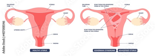 Asherman's uterus scar tissue cervix wall pelvic pain trauma and genital tube cramps abnormal injury deposit tract cancer HSG no period ovary PCOS polyp fibroid menstruation cycle loss inflammation
