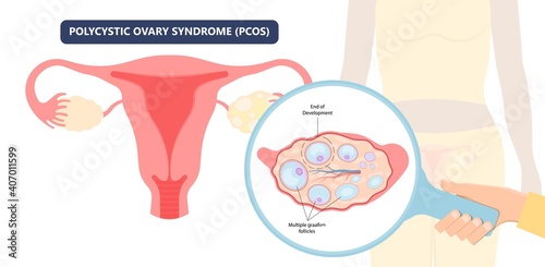 Cancer pelvic PCOS ovary Endo belly pain swelling uterus heavy ovaries cysts examine surgery remove pregnancy endobelly tube cycle period Fertility problem diagnosis menstruation cell polyp cervical