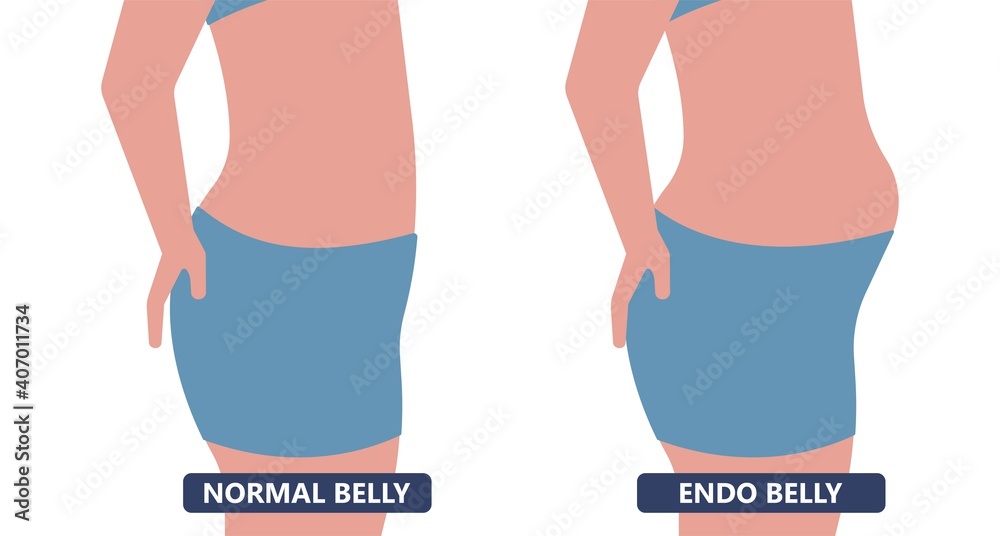 Cancer pelvic PCOS ovary Endo belly pain swelling uterus heavy ovaries