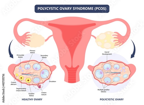 Cancer pelvic PCOS ovary Endo belly pain swelling uterus heavy ovaries cysts examine surgery remove pregnancy endobelly tube cycle period Fertility problem diagnosis menstruation cell polyp cervical photo