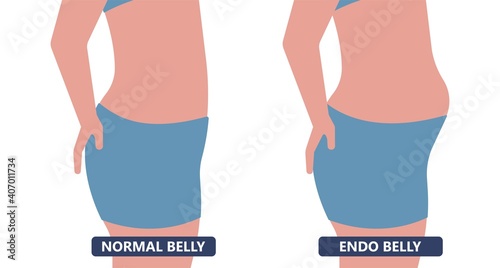 Cancer pelvic PCOS ovary Endo belly pain swelling uterus heavy ovaries cysts examine surgery remove pregnancy endobelly tube cycle period Fertility problem diagnosis menstruation cell polyp cervical