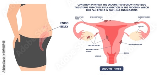 Cancer pelvic PCOS ovary Endo belly pain swelling uterus heavy ovaries cysts examine surgery remove pregnancy endobelly tube cycle period Fertility problem diagnosis menstruation cell polyp cervical