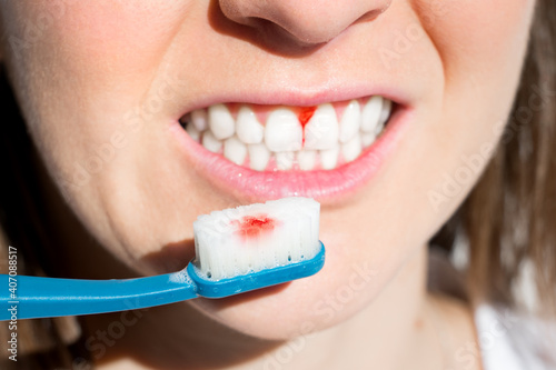 Woman with bleeding gums during teeth brushing. Hard toothbrush problem. Periodontal disease, avitaminosis, gingivitis, scurvy photo