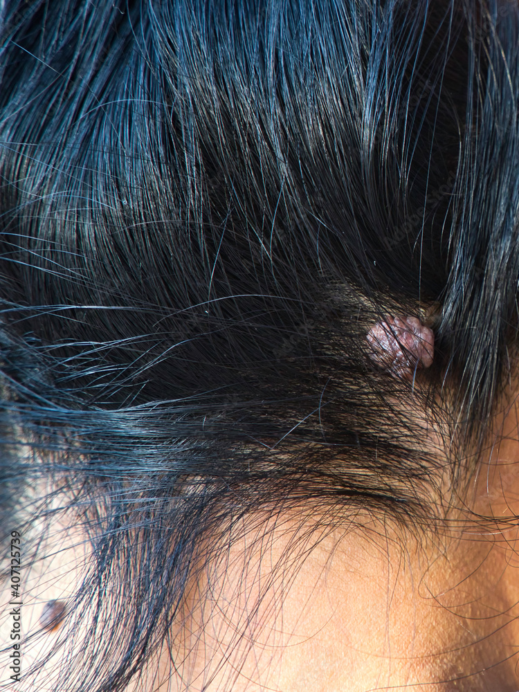 Skin Tag, Acrochordon on Female's Head. Stock Photo