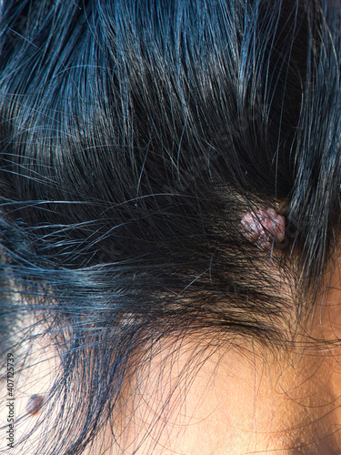 Skin Tag, Acrochordon on Female's Head.