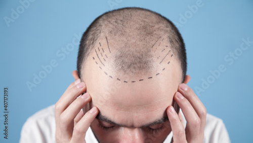 Foto Caucasian bald man. Before hair transplantation