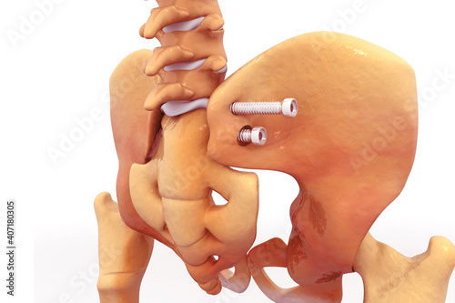 Hip fracture fixation surgery by screw. 3d illustration
