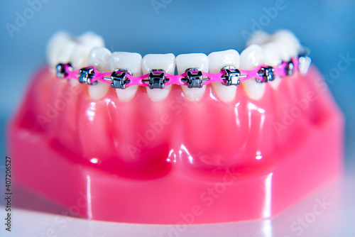 Braces are placed on the teeth in the artificial jaw against a light blue background. Macro photography