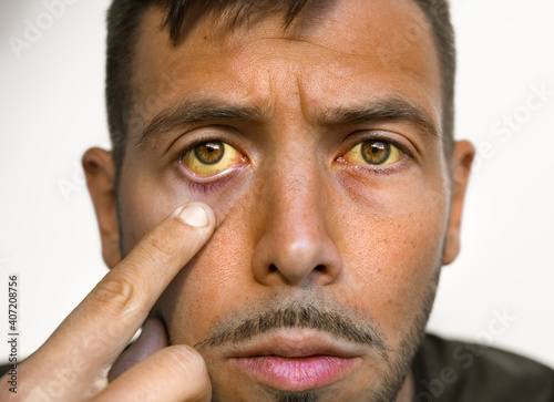 Young man with yellowish eyes and skin. Sign of problems with health and liver. Symptoms of high bilirubin, jaundice, hepatosis, hepatitis, cirrhosis, liver failure photo