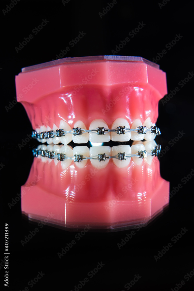 The braces are on the teeth in the artificial jaw on a black background. Macro photography The braces are on the teeth in the artificial jaw on a black background. Macro photography