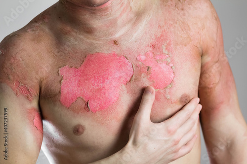 Man with a severe burn all over his body. Close up. Isolated on a gray background
