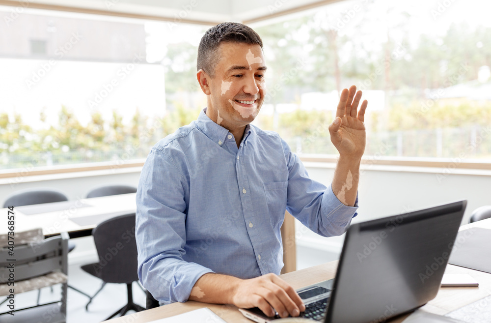 remote job, business and skin health concept - happy smiling middle-aged man with vitiligo on his face working at home office and having video call on laptop computer remote job, business and skin health concept - happy smiling middle-aged man with vitiligo on his face working at home office and having video call on laptop computer