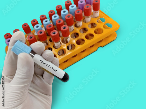 Biochemist or Lab Technologist holds Blood sample for factor 1 (fibrinogen) test, diagnosis of coagulation disorder. Medical testing concept. photo