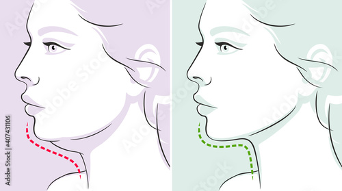 Woman profile, double chin, before-after. Woman face. Vector illustration