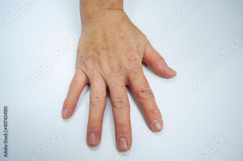 Hand with skin disease on a white background
