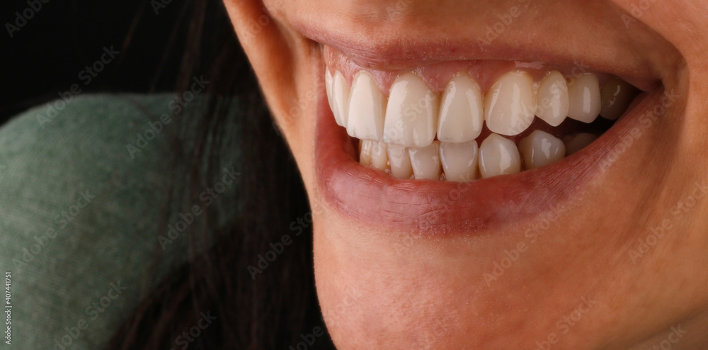 Obraz premium smile design with laminate veneers