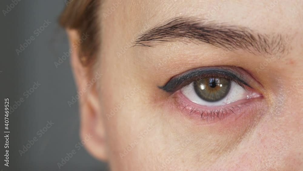 Close up of female eye with sore, inflamed, redness eyelid. Treatment