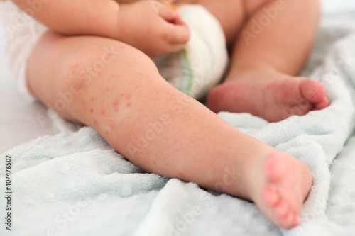 A small child with a red rash on the leg sits on the bed. Children is allergies. photo