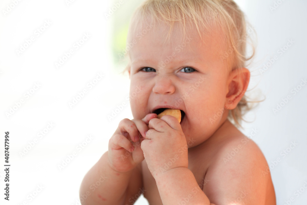 Portrait of a baby with a rash near the mouth. Enterovirus, allergy in a child. Portrait of a baby with a rash near the mouth. Enterovirus, allergy in a child.
