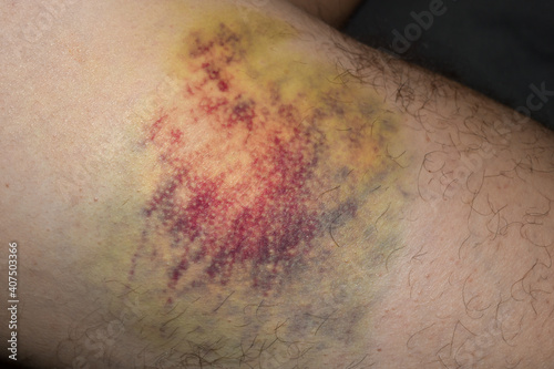 huge multi-colored bruise on body. Close-up is wounded leg with bruise and abrasion. Injured skin. Household injuries, harm to health, domestic violence. Bruise on man\'s body as result of an accident.