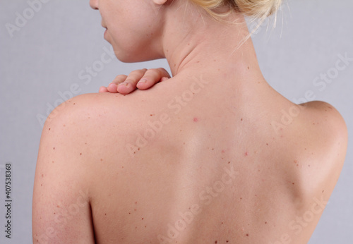 Pimples beautiful female on back, oily skin care concept