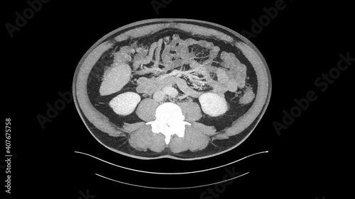 computed abdomen ct of a man in the mid 50th 