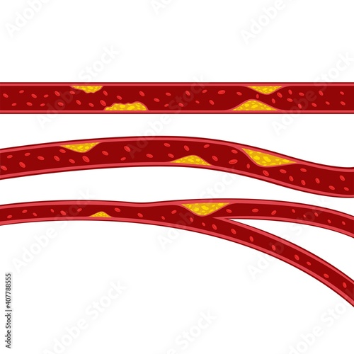 vector of cholesterol plaque illustratrion
