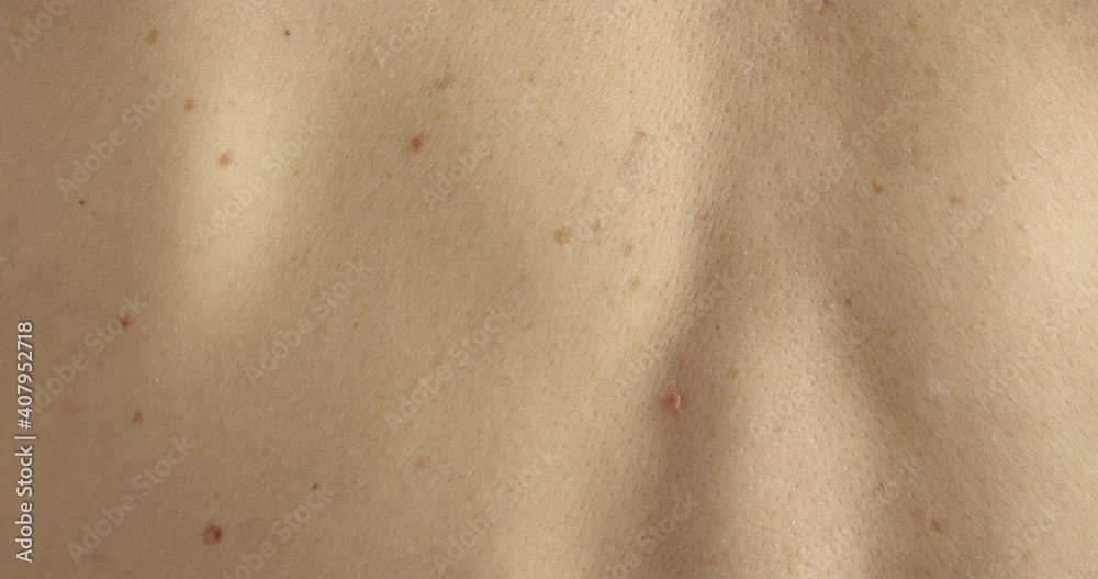 Close-up of large rashes or smallpox on the skin of an adult male. Pigmented spots on the back of a man. Skin of a man with moles. Acne. Problem skin. Skin care Close-up of large rashes or smallpox on the skin of an adult male. Pigmented spots on the back of a man. Skin of a man with moles. Acne. Problem skin. Skin care