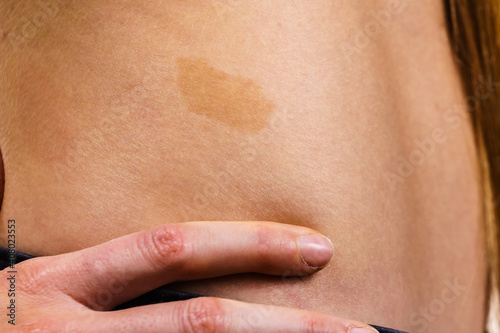 Closeup of brown birthmark on skin