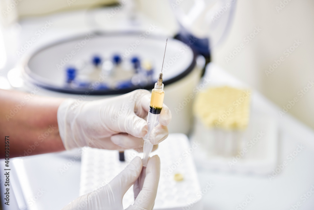 Platelet-Rich plasma preparation. Syringe with plasma in hands Platelet-Rich plasma preparation. Syringe with plasma in hands