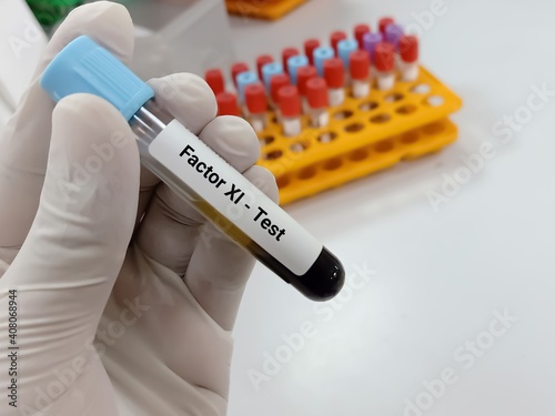 Biochemist or Lab Technologist holds Blood samples for factor XI or plasma thromboplastin antecedent diagnosis of coagulation disorder test in the laboratory background.