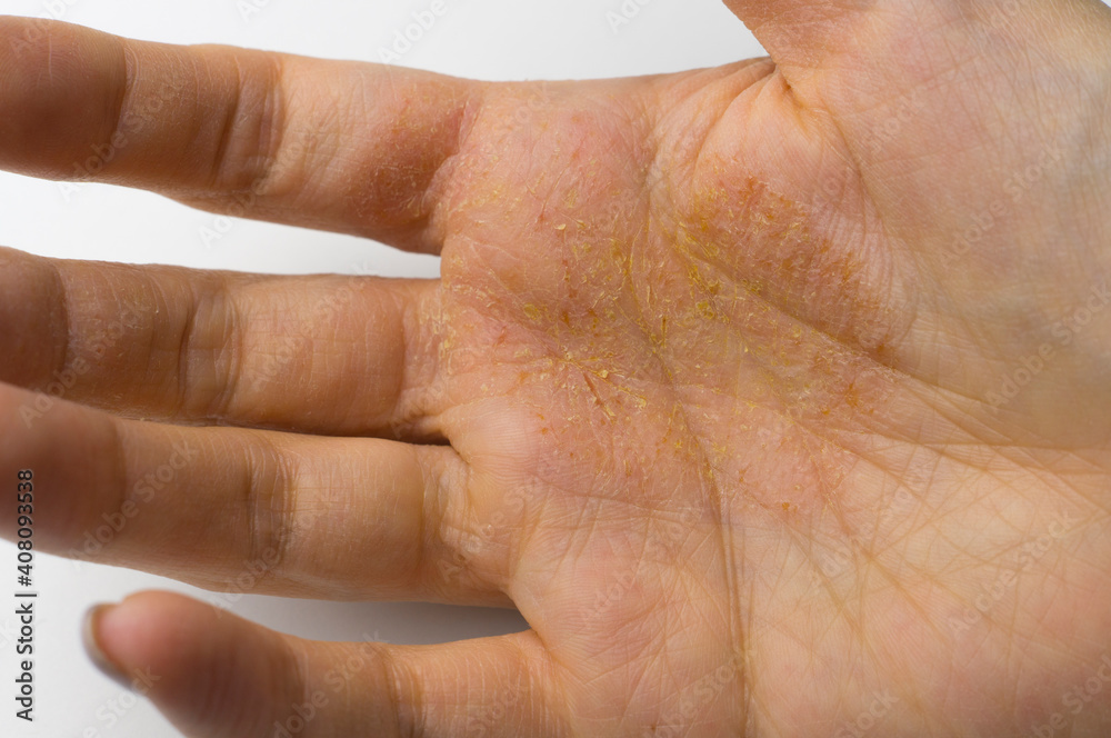 Female palm with skin disease, dermatitis on the palm.