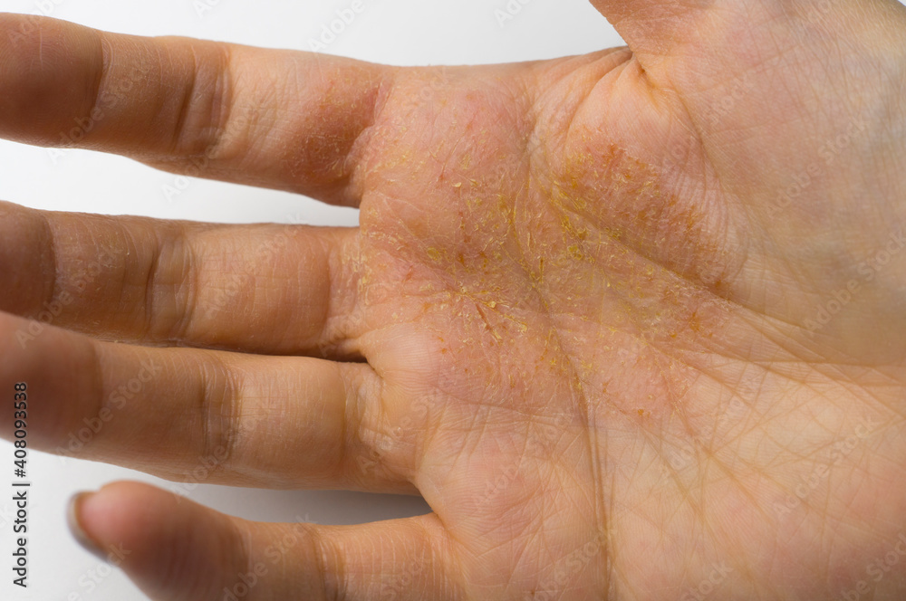 Female palm with skin disease, dermatitis on the palm. Female palm with skin disease, dermatitis on the palm.