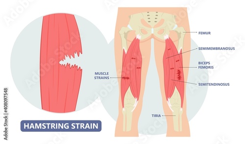 muscle leg knee biceps hip pulled tear injury grade pain running thigh examine cramp soccer football lacrosse pull sport athlete RICE torn skater player treat IT band first aid stretching back pelvis photo