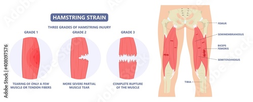 muscle leg knee biceps hip pulled tear injury grade pain running thigh examine cramp soccer football lacrosse pull sport athlete RICE torn skater player treat IT band first aid stretching back pelvis photo