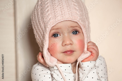 Portrait of a baby girl in a knitted hat with red cheek