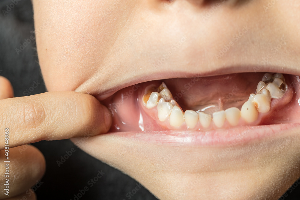 Fototapeta premium early childhood caries