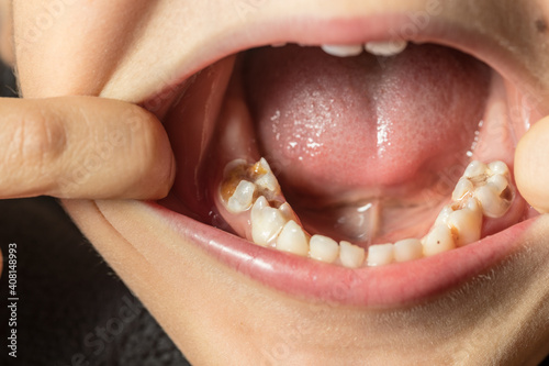 milk teeth caries, carious child teeth