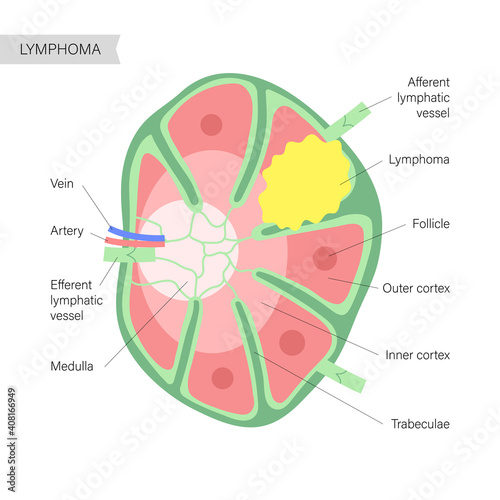Lymphoma cancer concept