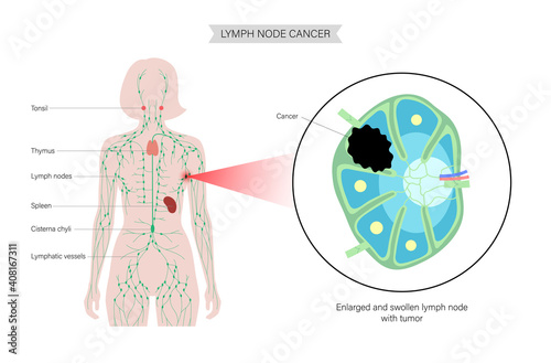Lymphoma cancer concept