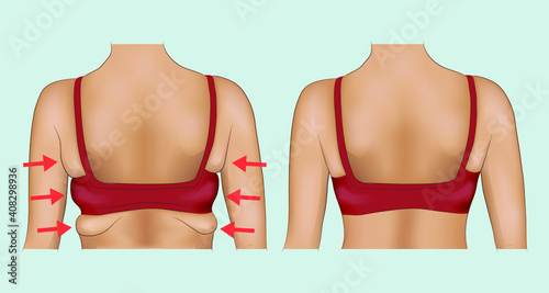 Armpits fat of a woman with arrow designation. Armpits fat before and after diet or surgery