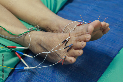 Chinese Acupuncture with Electrical stimulator on feet