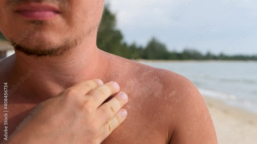 Unrecognized man touch heat skin burn on shoulder on sea coast background. Recreational activity of sun bathing. Unrecognized man touch heat skin burn on shoulder on sea coast background. Recreational activity of sun bathing.
